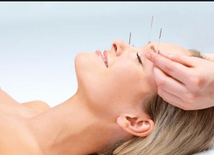 Achieving Wellness in Sydney: Embracing the Ancient Art of Acupuncture